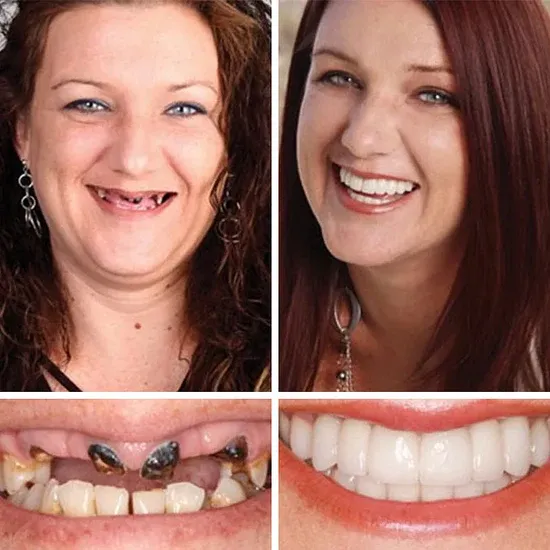 🌎Ends Today: 49% OFF!⏰KLENIMORE™ Custom-Fit Smile Support Kit — Strong Suction Feel & Natural-Looking Fit