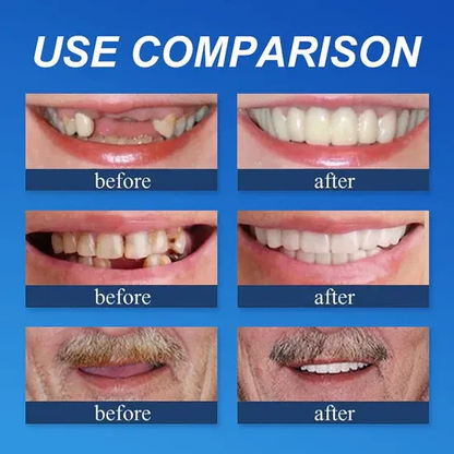 🌎Ends Today: 49% OFF!⏰KLENIMORE™ Custom-Fit Smile Support Kit — Strong Suction Feel & Natural-Looking Fit