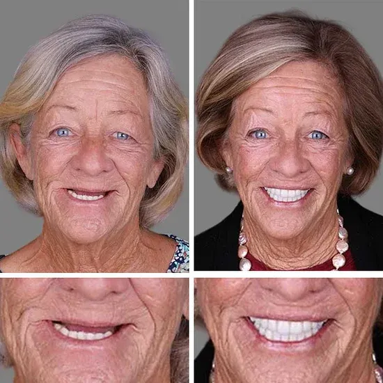 🌎Ends Today: 49% OFF!⏰KLENIMORE™ Custom-Fit Smile Support Kit — Strong Suction Feel & Natural-Looking Fit