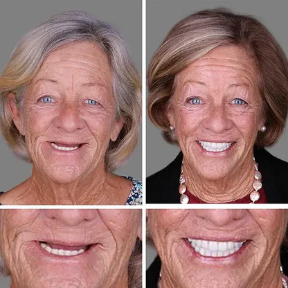 🌎Ends Today: 49% OFF!⏰KLENIMORE™ Custom-Fit Smile Support Kit — Strong Suction Feel & Natural-Looking Fit
