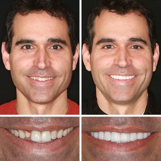 🌎Ends Today: 49% OFF!⏰KLENIMORE™ Custom-Fit Smile Support Kit — Strong Suction Feel & Natural-Looking Fit